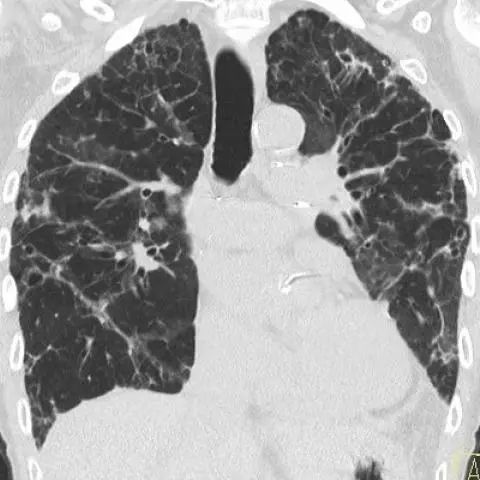 Follow-up CT, 2.5 years after transplantation, shows the same lesion with volume loss, diffuse cylindrical bronchiectasis, and perihilar ground-glass opacities.