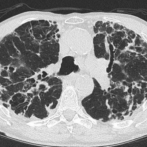 Axial CT confirming upper lobe subpleural reticulations and consolidations.