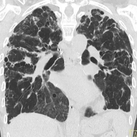 Coronal CT showing subpleural reticulations and consolidation in both upper lobes, consistent with restrictive allograft syndrome (RAS) and acute fibrinous organising pneumonia (AFOP) pattern.