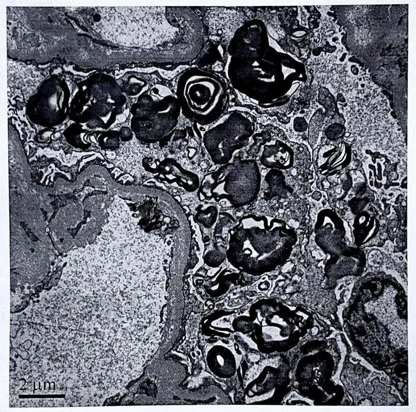 Electron microscope image showing a cell section with numerous dark, irregularly shaped structures, possibly organelles, within a lighter background. A scale bar indicates a measurement of two micrometers.